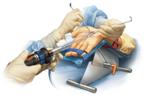 laparoskopia cieśni nadgarstka