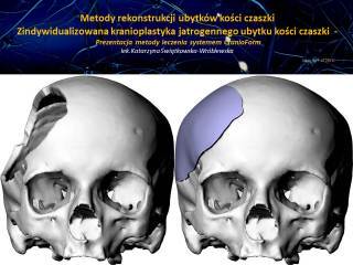 rekonstrukcja czaszki
