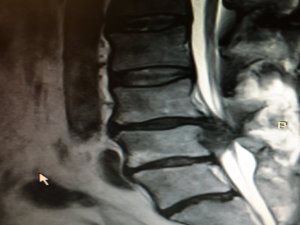 dyskopatia lędźwiowa MRI